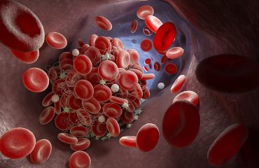 Infiammazione-cronica-e-cuore-rischio-cause-e-prevenzione infiammazione cronica e cuore rischio cause e prevenzione